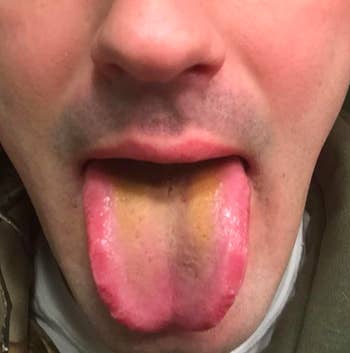 Reviewer with brownish tongue from buildup 