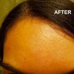 Reviewer's forehead two weeks after use, free of acne 