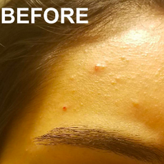 Reviewer's forehead with fungal acne 