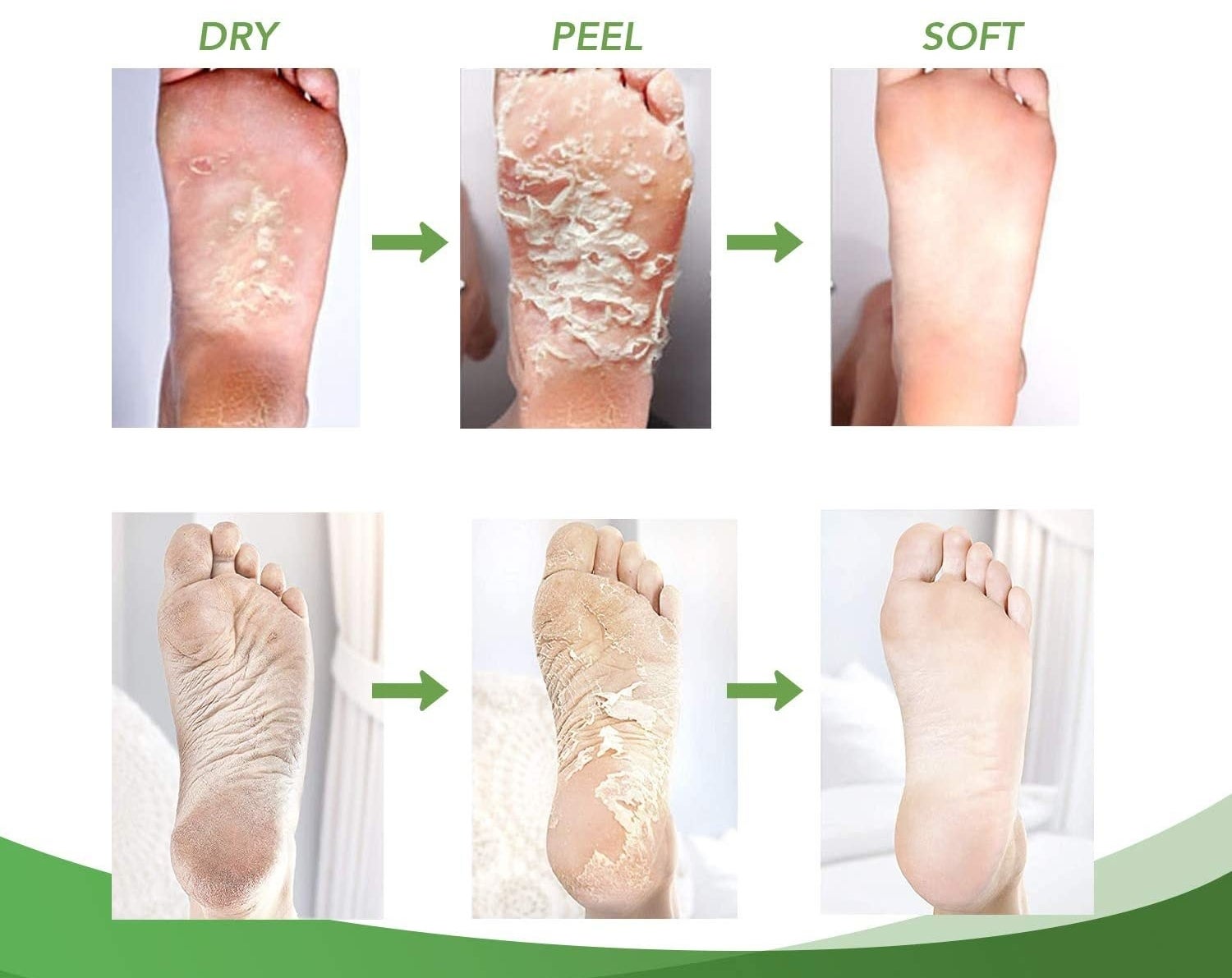 A progress photo showing dead skin peeling off the foot 
