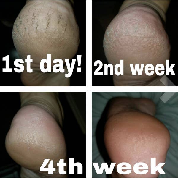 Images of a reviewer&#x27;s dry, cracked heel on day one with improvements by the second week and a smooth heel by the fourth week 