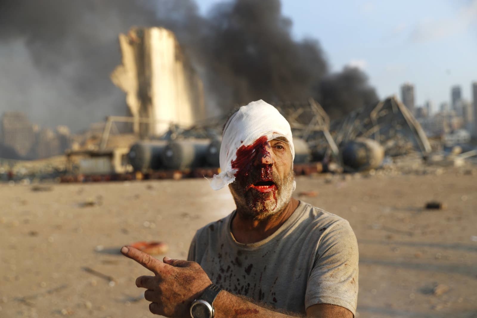 A man with one bloody bandaged eye points with smoke and wreckage behind him