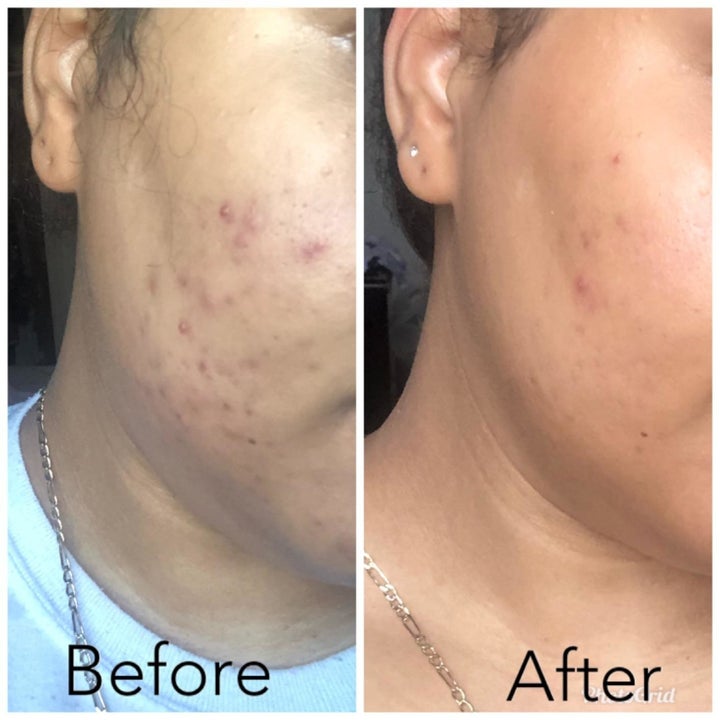 Reviewer's before and after showing the exfoliant dramatically reduced hyperpigmentation on their cheek and made the skin smoother