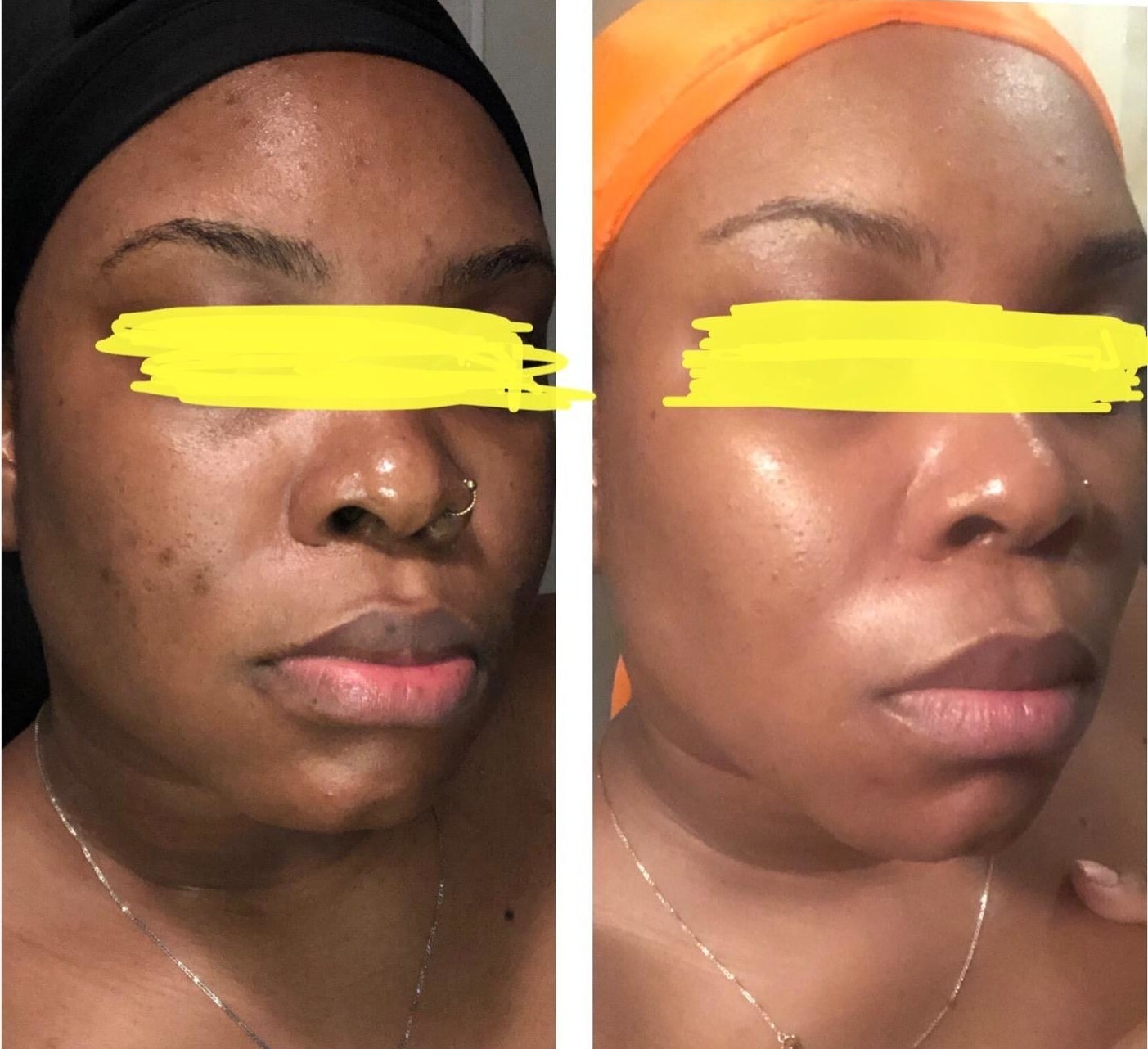Before and after of reviewer who used the cleanser showing that it evened their skin tone, improved texture, and made their skin glow