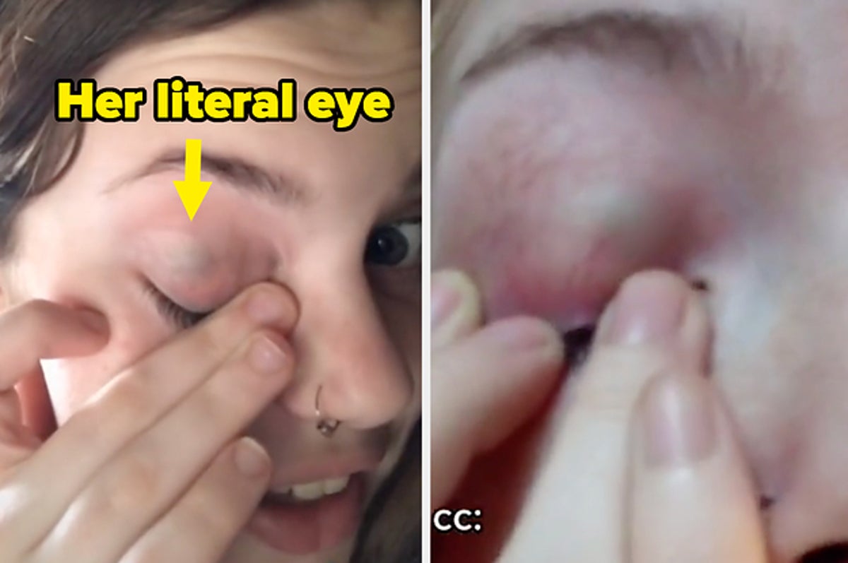 whats the difference between shell shock and normal eyes｜TikTok Search