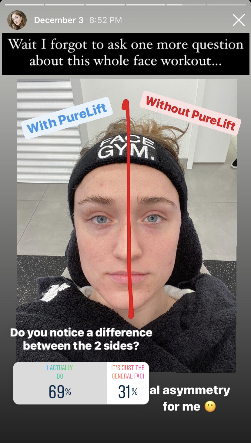 An Instagram poll asking &quot;Do you notice a difference between the two sides?&quot;  and two answers of &quot;I actually do&quot; with 69%, and &quot;it&#x27;s just the general facial asymmetry for me&quot; with 31%