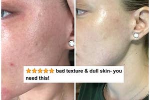 A reviewer's skin before and after use, with reduced texture, acne, and redness after with five stars and text "bad texture and dull skin, you need this"