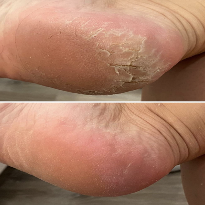 Reviewer before and after feet using foot scraper