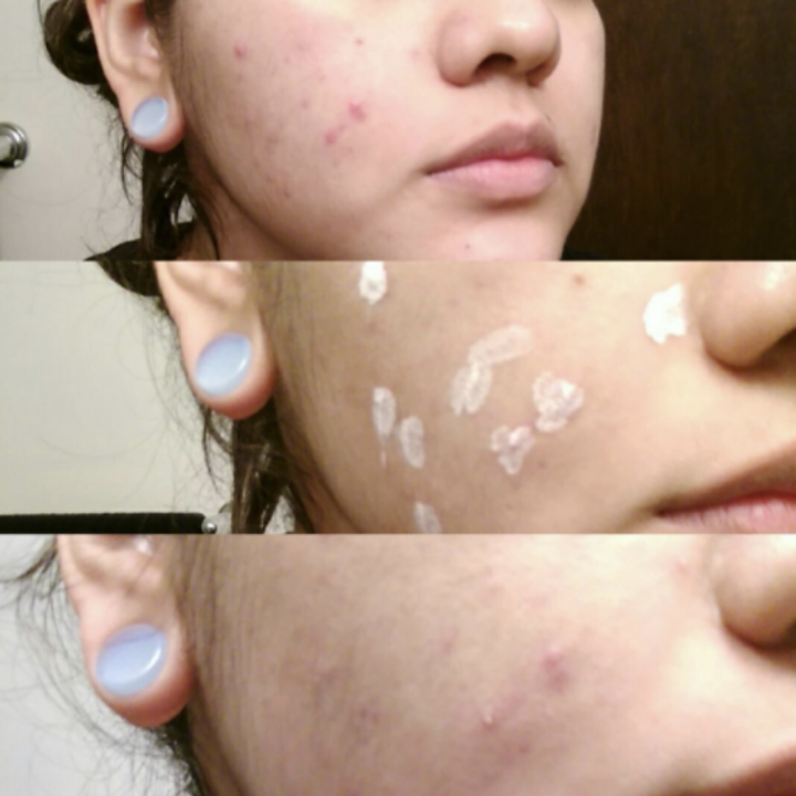 Reviewer before during and after using drying lotion