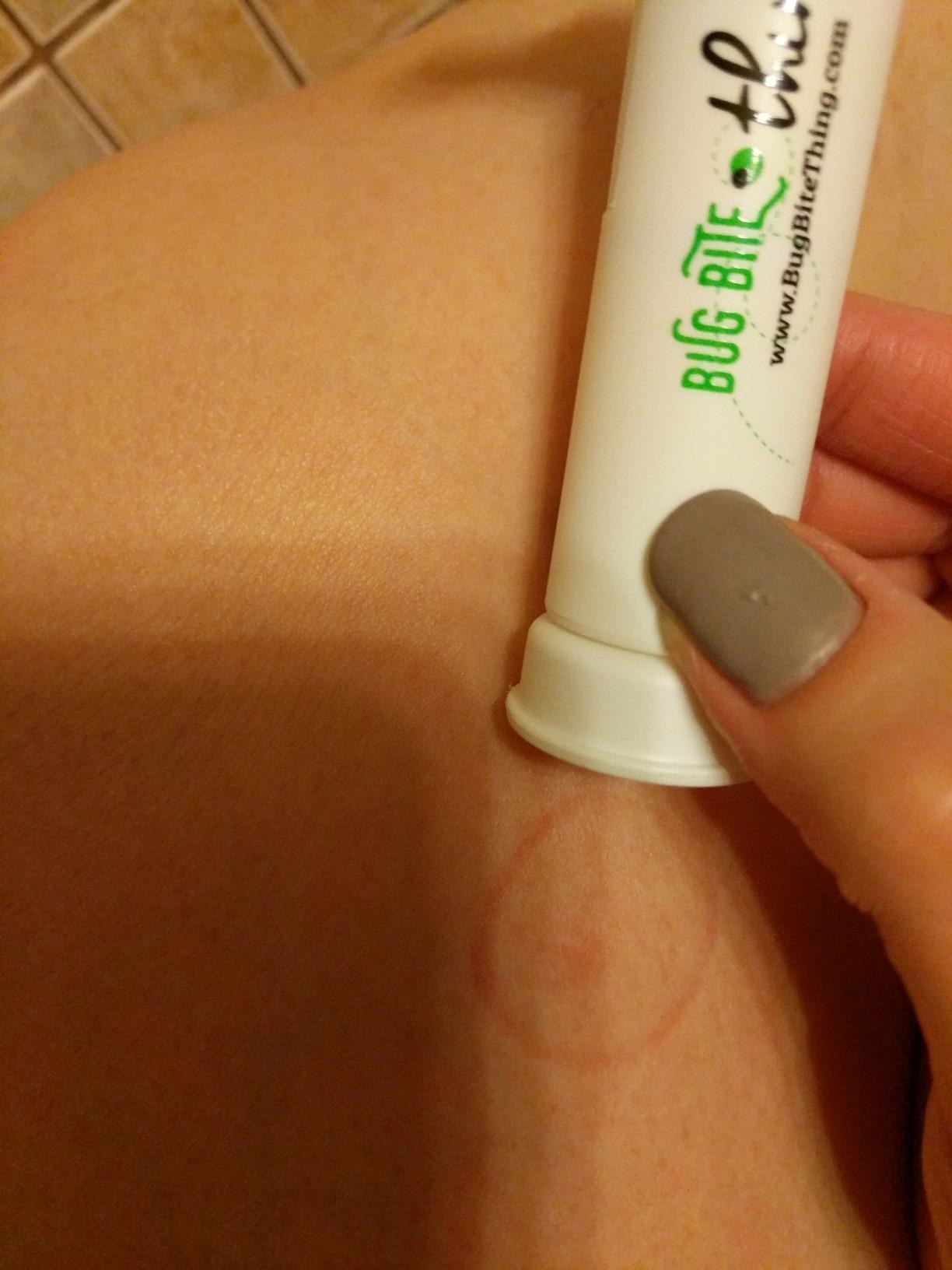 a woman's healed skin after using the bug bite thing