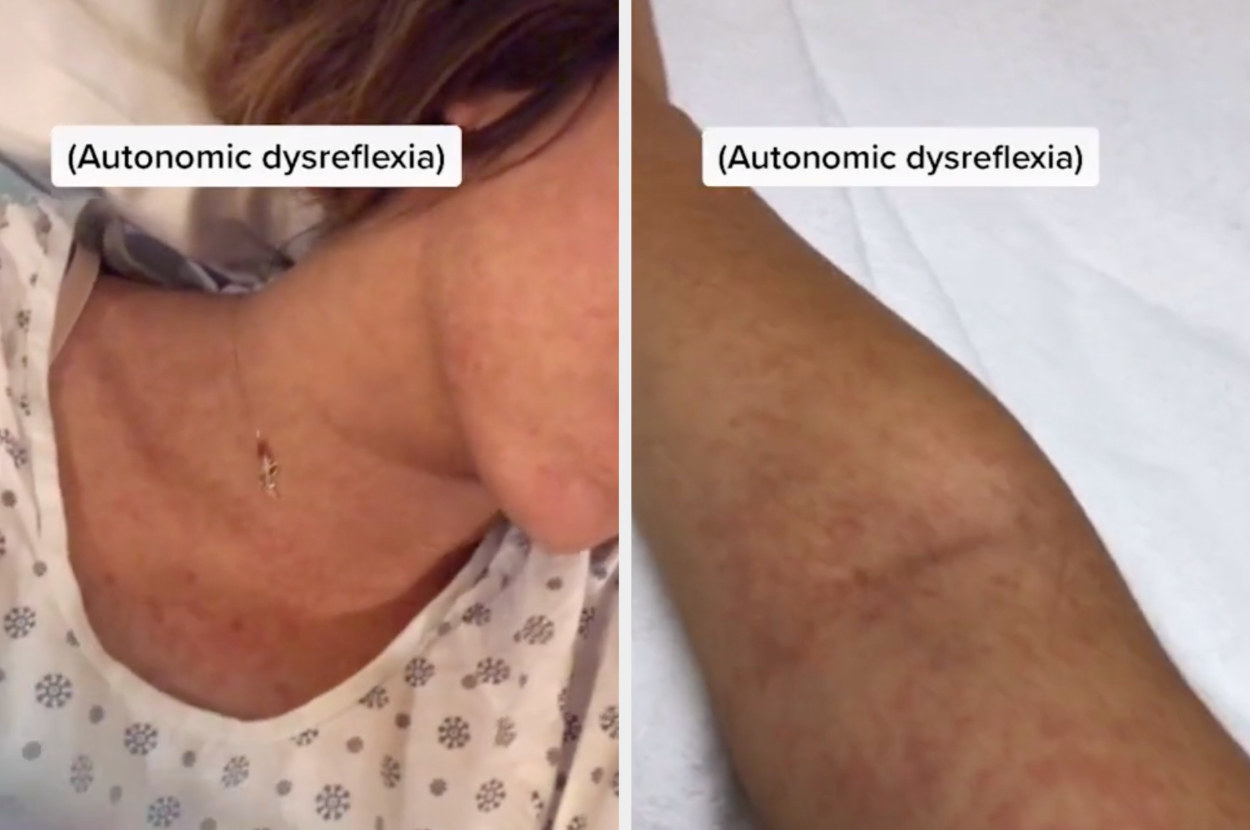 Jessica&#x27;s skin turning red from autonomic dysreflexia