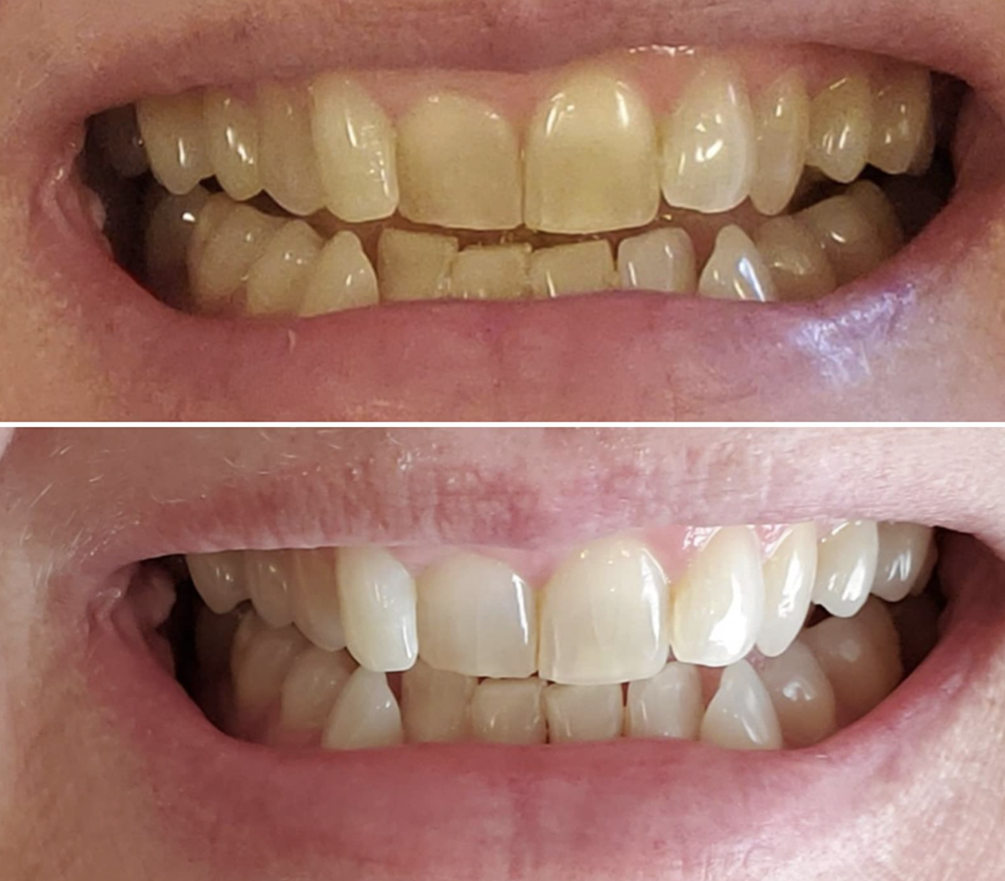 on top, a reviewer&#x27;s teeth looking yellow, and on the bottom, the same reviewer&#x27;s teeth now looking more white