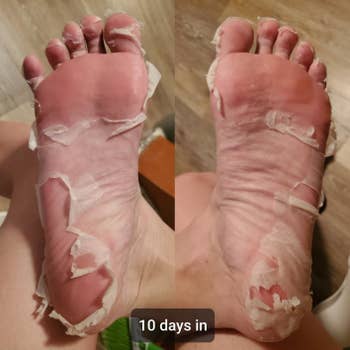 A reviewer's photo of their peeling skin 10 days after using the foot mask