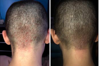 back of reviewer's head with red marks under the hairline and an after pic with the spot significantly less red 