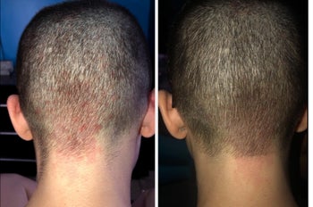 A reviewer image of the back of their head with red marks under the hairline and an after pic with the spot significantly less red 