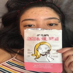 Reviewer wears small, round Avarelle pimple patches on forehead while holding a package of them 