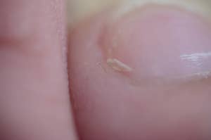 An image of a hangnail