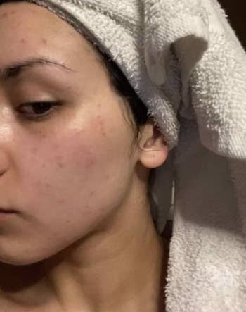 a reviewer showing acne on their face