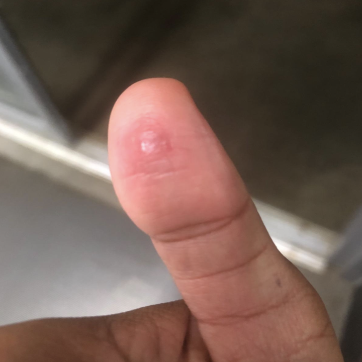 the same reviewer showing the wart practically gone after using the pads