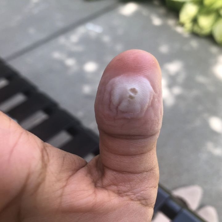 a reviewer showing a wart on their thumb