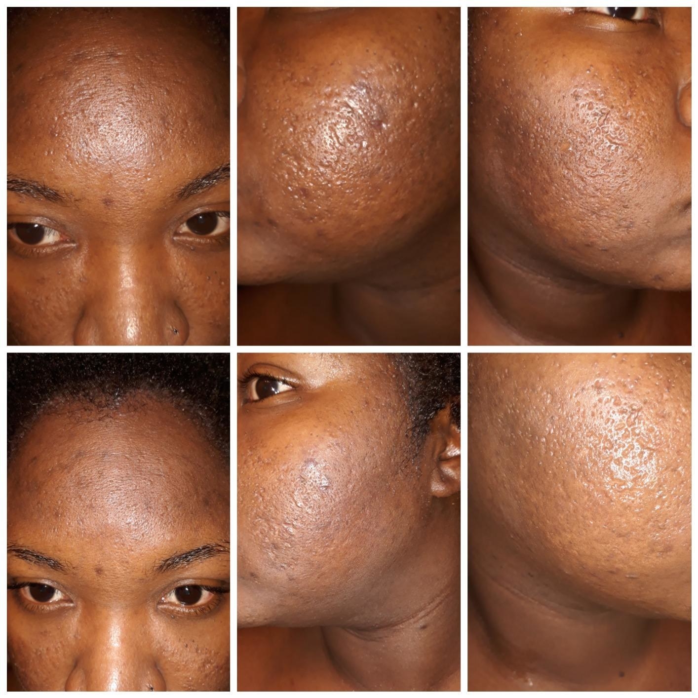 Before and after photos of reviewer showing the scrub helped brighten their skin tone and even out hyperpimentation