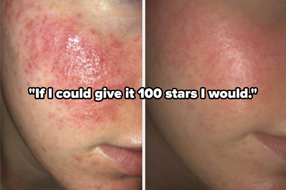 15 Products For Cystic Acne Our Readers Actually Swear By Face mapping is an invaluable tool for diagnosing acne.