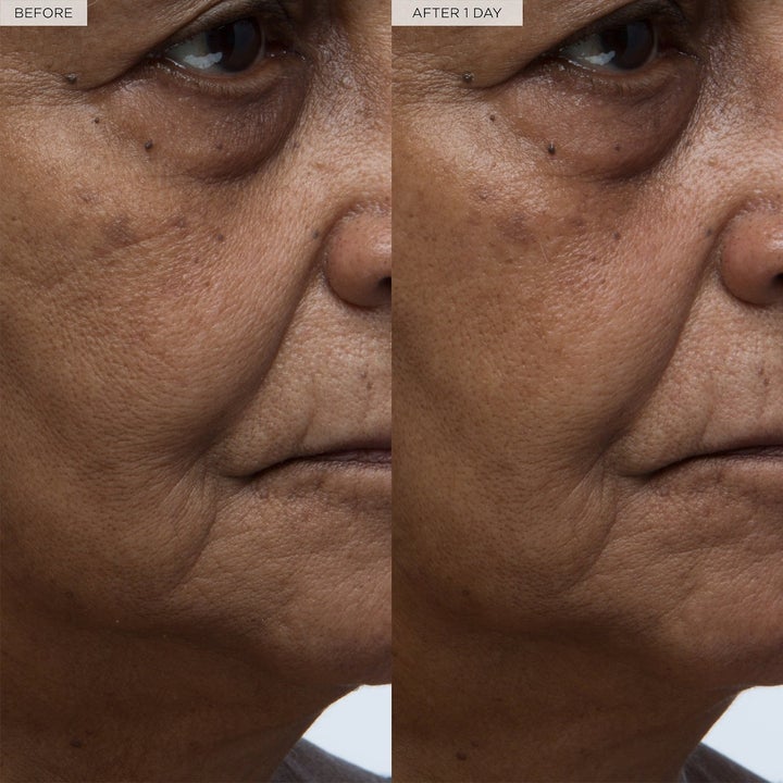 before and after photo of model with prominent fine lines on left and visibly reduced fine lines on right