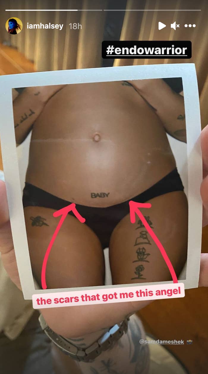 Halsey shows the scars on her lower stomach just above her bikini line. Above the scars  is a tattoo of  the word &quot;Baby&quot;