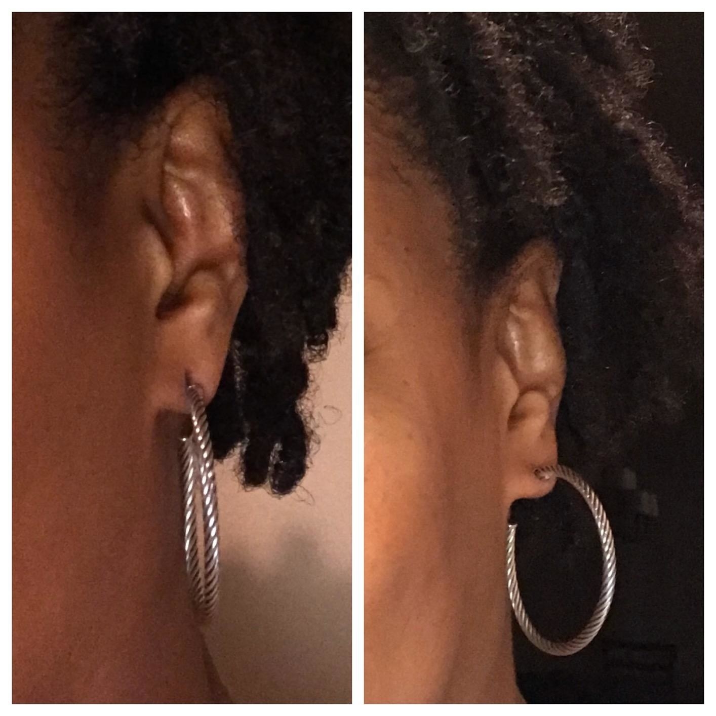 Amazon reviewer showing before and after effects of using ear lobe patches with heavy hoop earrings