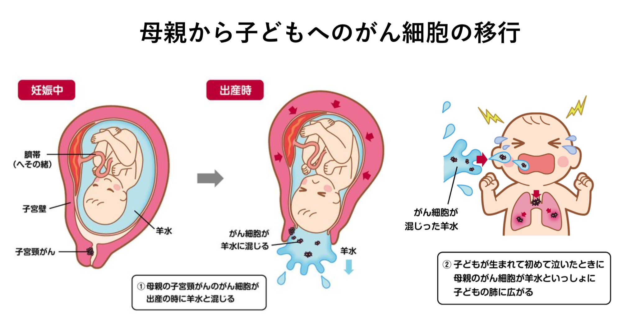 妊娠と同時に子宮頸がんが見つかった女性の話