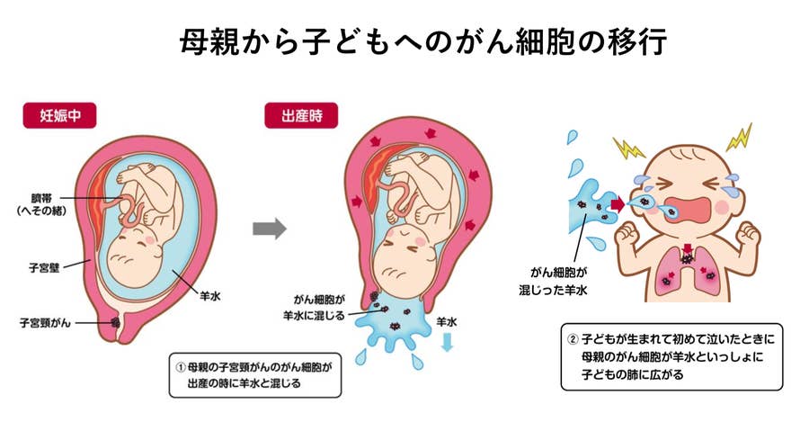 子宮頸がんの母親が出産 がん細胞が羊水に 赤ちゃんが吸い込んで肺のがんに