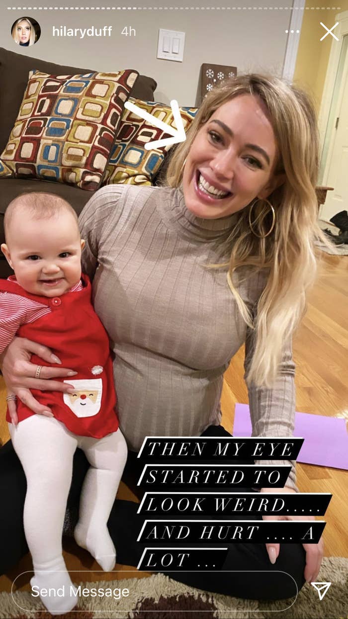 Hilary Duff Got An Eye Infection From Covid 19 Tests