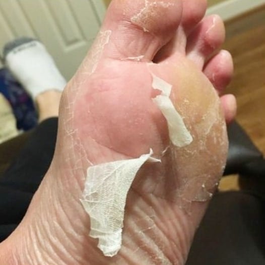 A close-up of a peeling foot as a result of using the foot peeler
