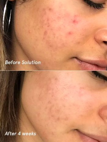 A before-and-after photo showing a person's acne on their cheek clearing up after four weeks of using the Solution