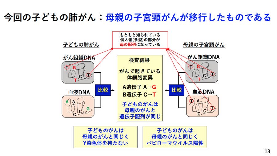 子宮頸がんの母親が出産 がん細胞が羊水に 赤ちゃんが吸い込んで肺のがんに