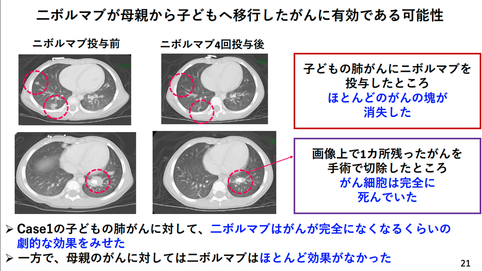 子宮頸がんの母親が出産 がん細胞が羊水に 赤ちゃんが吸い込んで肺のがんに