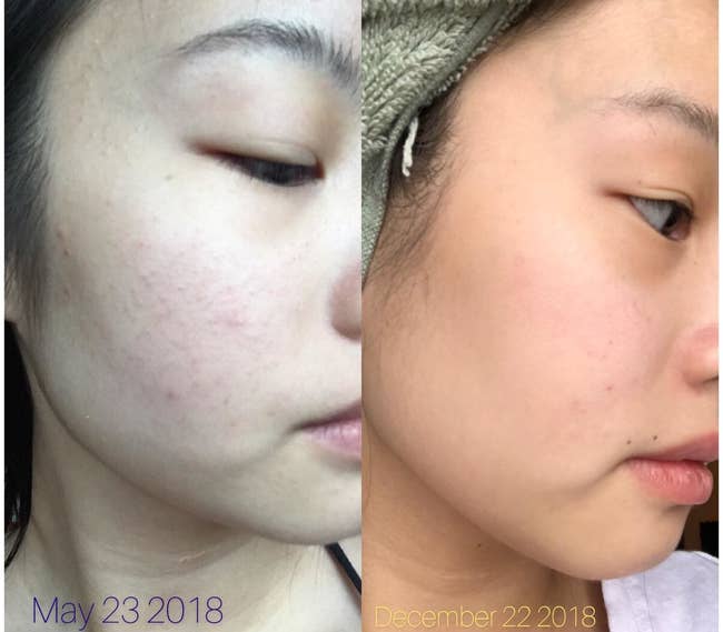 A two-paneled reviewer photo showing a face with red acne on the cheeks on the left, and a face with a clear complexion on the right. 