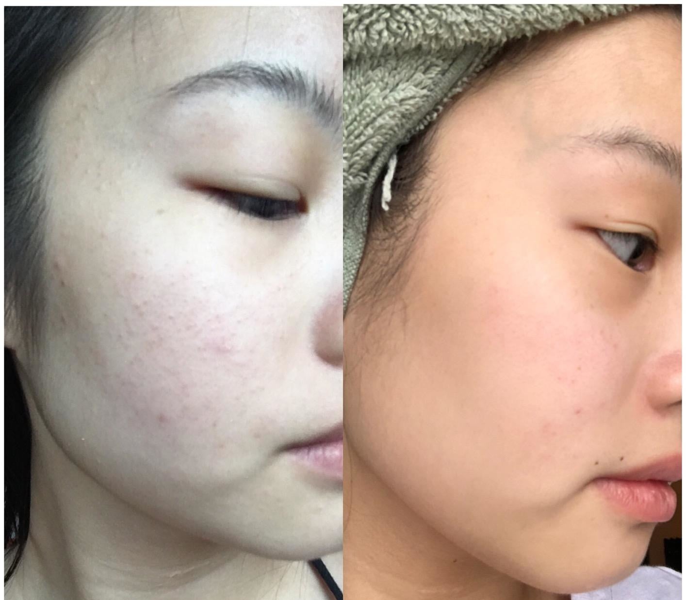 A two-paneled reviewer photo showing a face with red acne on the cheeks on the left, and a face with a clear complexion on the right. 