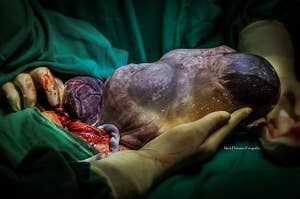A baby is born still in the amniotic sac