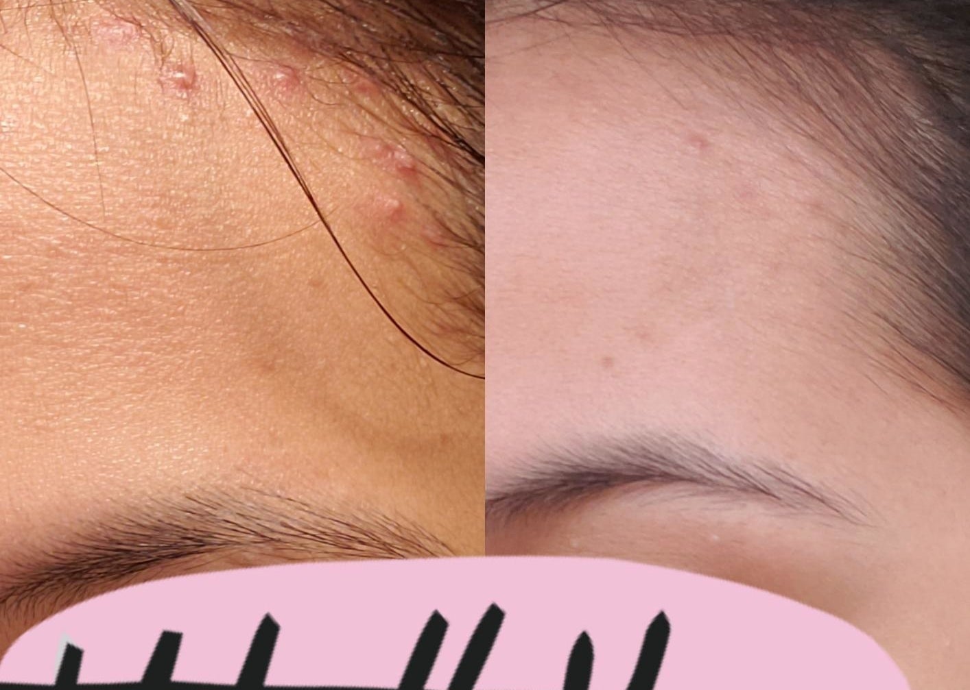 reviewer&#x27;s before and after picture which shows acne on their forehead and then a near-clear forehead