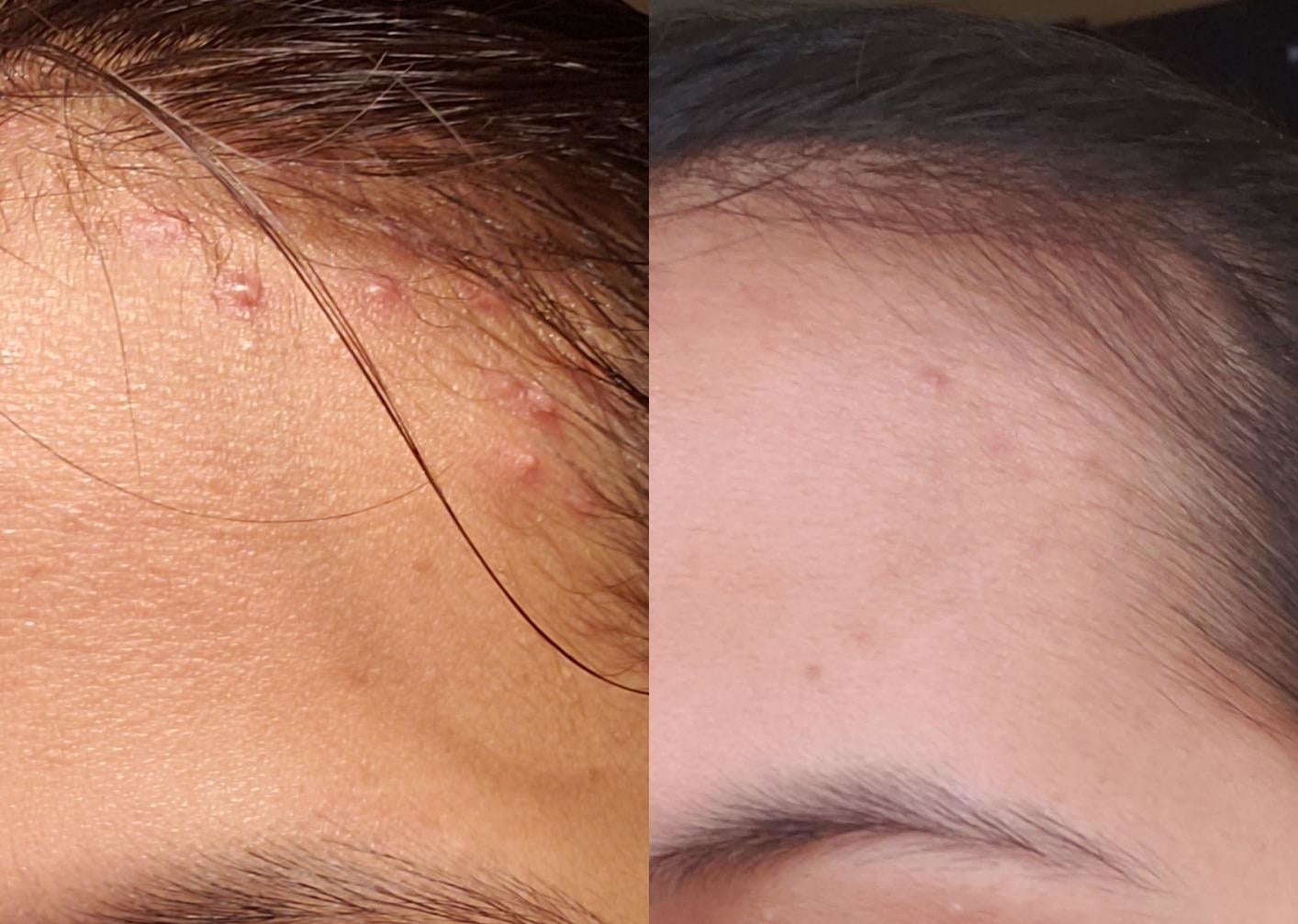 reviewer&#x27;s before and after picture which shows acne on their forehead and then a near-clear forehead