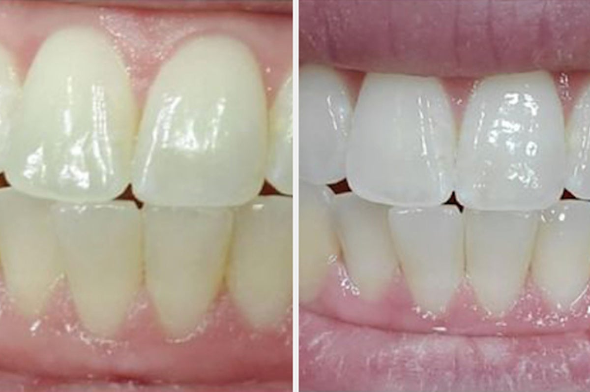 zimba teeth whitening
