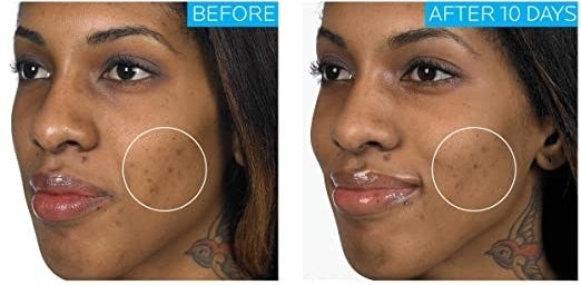 A split image showing a face with dark spots on the cheek and text reading "Before" and the same face with the appearance of the dark spots reduced and text reading "After 10 Days"