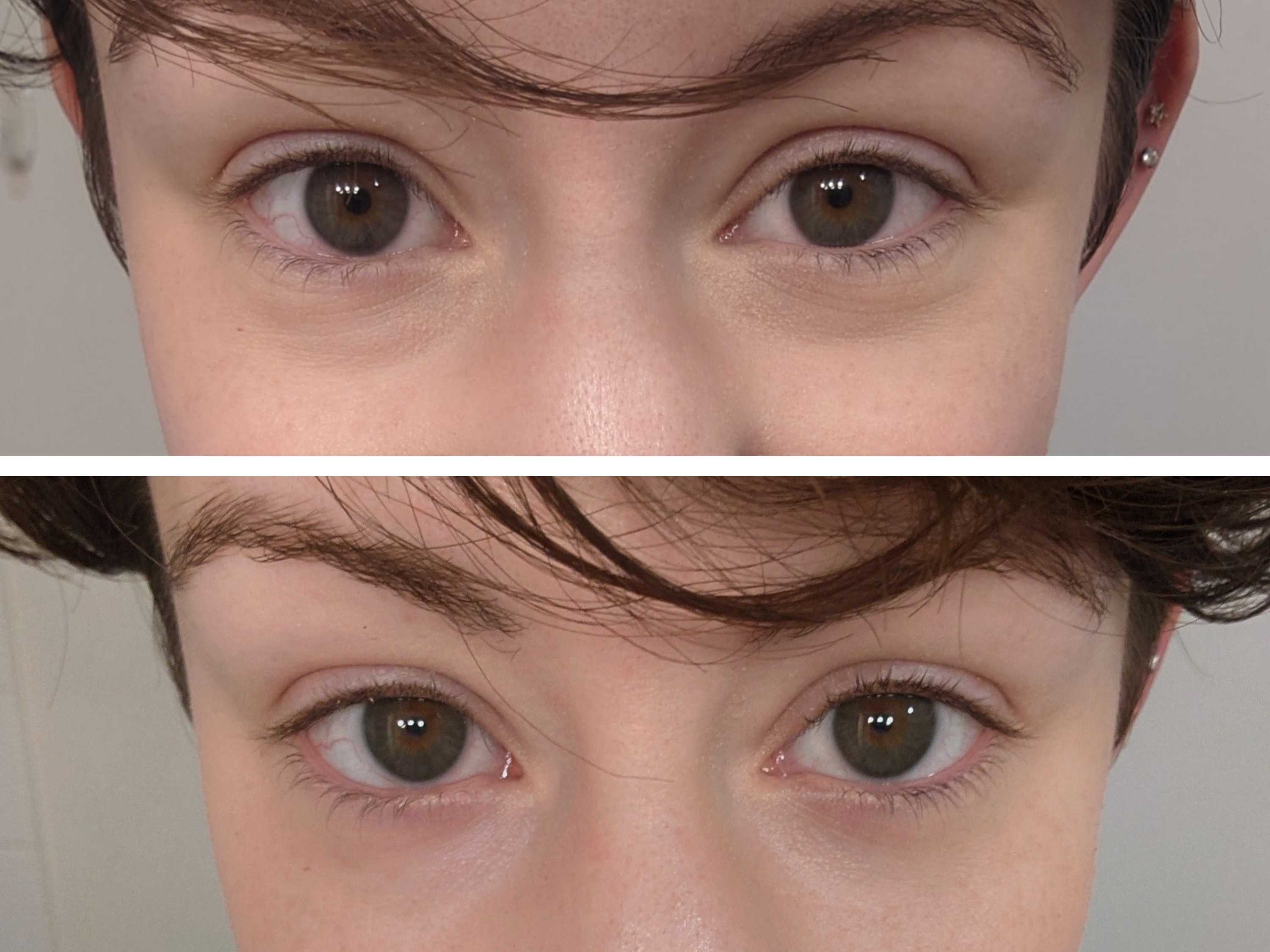 Richesse Eyes Facial Collagen Injection Eyes Around Eye Bag Dark