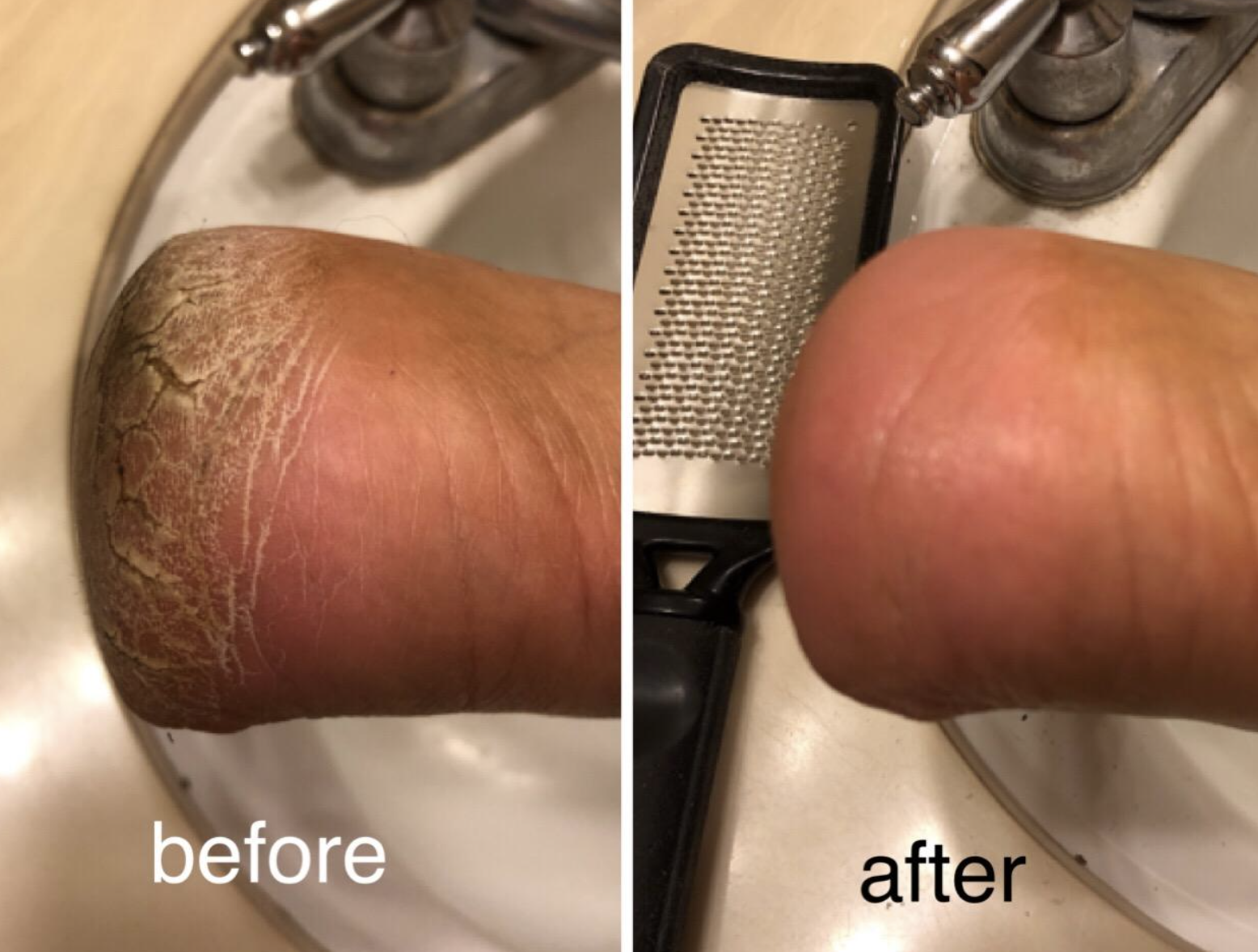 a before-and-after photo of a reviewer&#x27;s cracked heel now looking soft and smooth