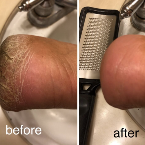 a before-and-after photo of a reviewer's cracked heel now looking soft and smooth