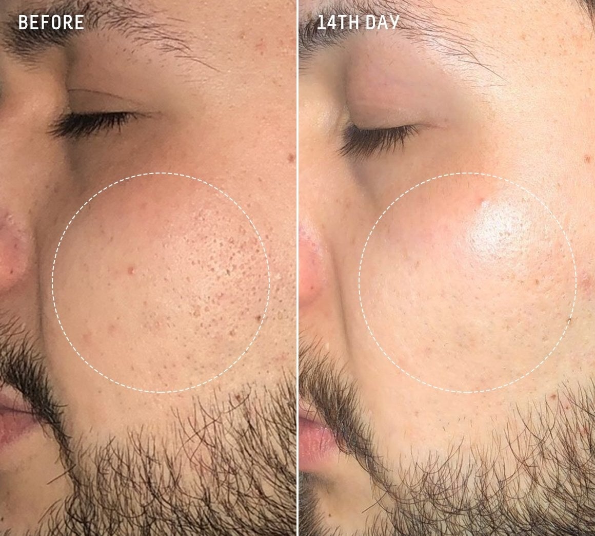 Biossance customer before and after photo showing their skin red and bumpy, then completely soft and smooth after fourteen days of using the serum 