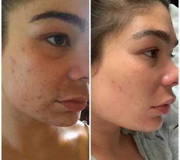 A split reviewer image showing a face with red bumps and acne scars on the left, and the same face with fewer bumps and scars on the right 