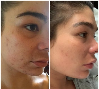 A split reviewer image showing a face with red bumps and acne scars on the left, and the same face with fewer bumps and scars on the right 