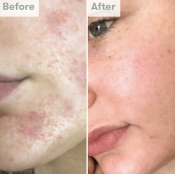 before/after showing red skin and smoother clearer skin after using the balm